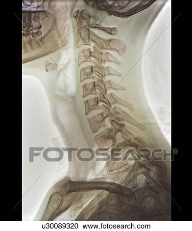 Normal neck. Coloured X-ray of the cervical spine of a 27 year old. View Large Photo Image Stock Image - Normal neck. Coloured X-ray of the cervical spine of a 27 year old.. Fotosearch
