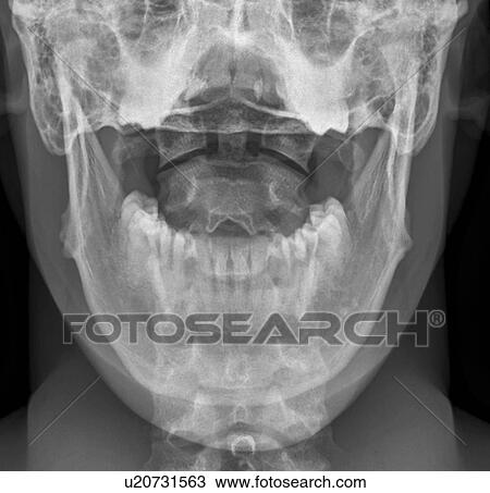 Stock Image - Normal neck. Frontal X-ray of the joint between the skull and the neck.. Fotosearch