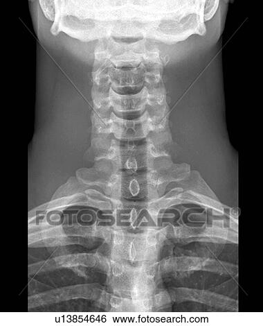 Stock Photograph - Normal neck. X-ray of the cervical spine of a 24 year old.. Fotosearch