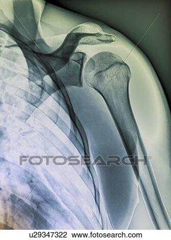 Stock Image - Normal shoulder. Coloured X-ray of the healthy left shoulder of a 28 year old patient.. Fotosearch