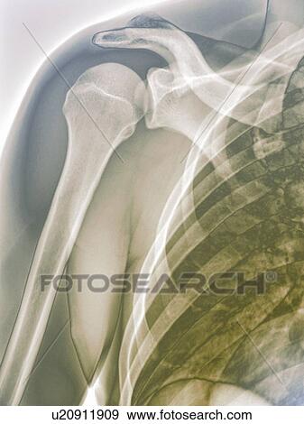 Stock Photo - Normal shoulder. Coloured X-ray of the healthy right shoulder of a 28 year old patient.. Fotosearch