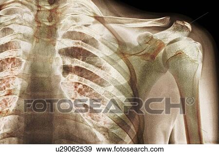Stock Photo - Normal shoulder. Coloured X-ray of the shoulder of a 19 year old man.. Fotosearch