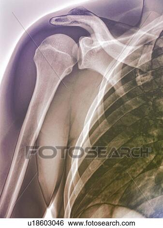 Stock Photograph - Normal shoulder. Coloured X-ray of the healthy right shoulder of a 28 year old patient.. Fotosearch