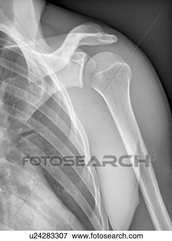 Normal shoulder. X-ray of the healthy left shoulder of a 28 year old patient. View Large Photo Image Stock Photo - Normal shoulder. X-ray of the healthy left shoulder of a 28 year old patient.. Fotosearch