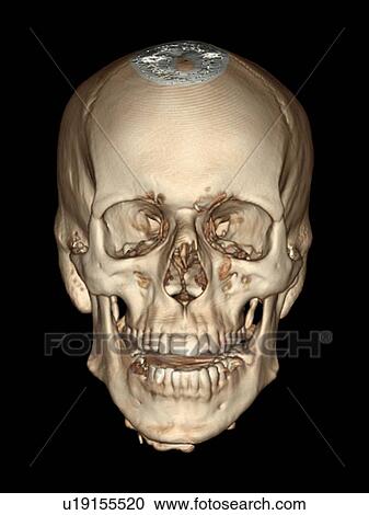 Stock Image - Normal skull. Coloured 3D computed tomography (CT) scan of the healthy skull of a 36 year old patient.. Fotosearch