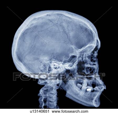 Stock Image - Normal skull. Coloured X-ray of the head of a 28 year old patient.. Fotosearch