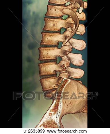 Stock Photo - Normal spine. Coloured computed tomography (CT) scan of the lumbar spine of a 45 year old.. Fotosearch
