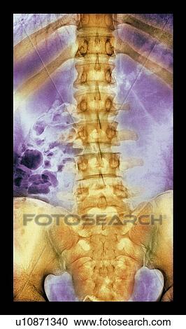 Stock Image - Normal spine. Coloured X-ray of the spine of a 24 year old man.. Fotosearch