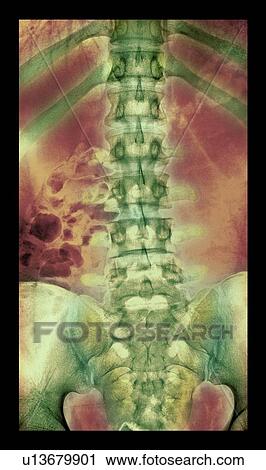 Normal spine. Coloured X-ray of the spine of a 24 year old man. View Large Photo Image Stock Image - Normal spine. Coloured X-ray of the spine of a 24 year old man.. Fotosearch