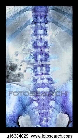Stock Photo - Normal spine. Coloured X-ray of the spine of a 24 year old man.. Fotosearch
