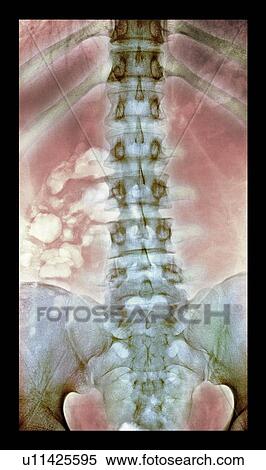 Stock Photography - Normal spine. Coloured X-ray of the spine of a 24 year old man.. Fotosearch