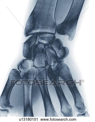 Normal wrist, coloured X-ray. View Large Photo Image Stock Image - Normal wrist, coloured X-ray.. Fotosearch