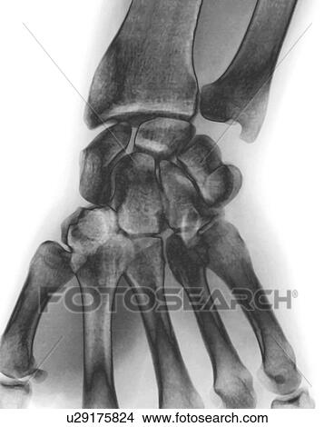 Normal wrist, X-ray. View Large Photo Image Picture - Normal wrist, X-ray.. Fotosearch