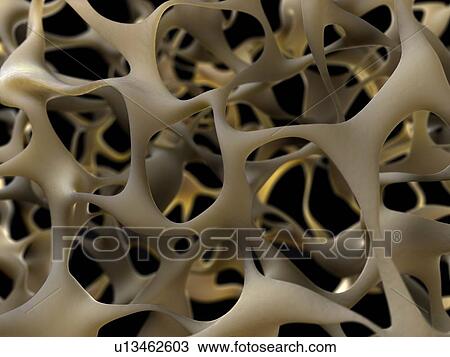 Stock Image - Osteoporotic bone, computer artwork.. Fotosearch