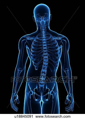 Stock Image - Scoliosis. Computer artwork of a man with a sideways curvature (scoliosis) of the spine.. Fotosearch