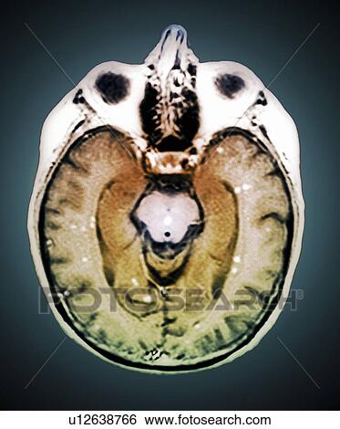 Secondary brain cancer. Coloured magnetic resonance imaging (MRI) scan of an axial section through the brain of a 45 year old patient showing numerous malignant (cancerous) tumours (white). This is a secondary cancer that has metastasised (spread) from a View Large Photo Image Stock Photograph - Secondary brain cancer. Coloured magnetic resonance imaging (MRI) scan of an axial section through the brain of a 45 year old patient showing numerous malignant (cancerous) tumours (white). This is a secondary cancer that has metastasised (spread) from a . Fotosearch