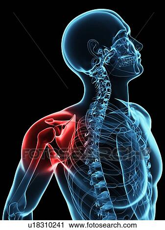 Shoulder pain, conceptual computer artwork. View Large Photo Image Stock Image - Shoulder pain, conceptual computer artwork.. Fotosearch