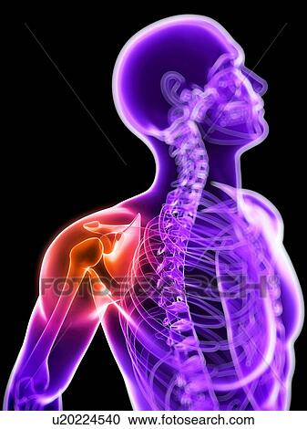 Stock Image - Shoulder pain, conceptual computer artwork.. Fotosearch