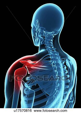 Stock Photograph - Shoulder pain, conceptual computer artwork.. Fotosearch