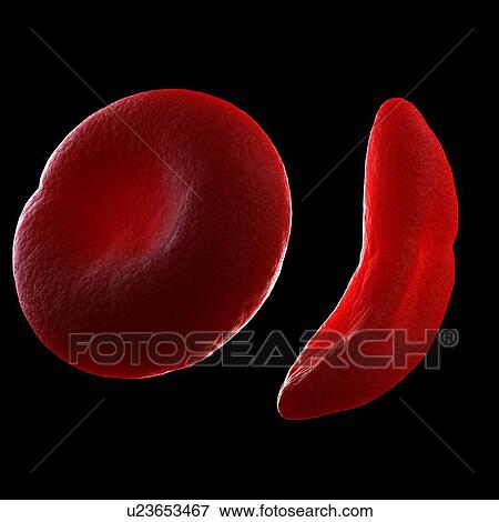Sickle cell anaemia, computer artwork. View Large Photo Image Stock Photo - Sickle cell anaemia, computer artwork.. Fotosearch