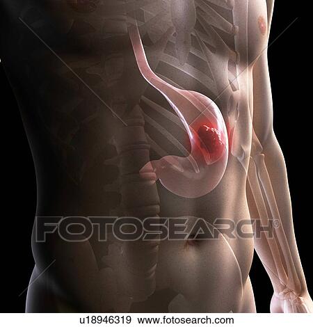 Stomach cancer, computer artwork. View Large Photo Image Stock Photo - Stomach cancer, computer artwork.. Fotosearch