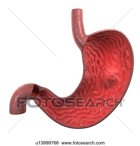 Stomach cancer, computer artwork. View Large Photo Image Stock Photograph - Stomach cancer, computer artwork.. Fotosearch