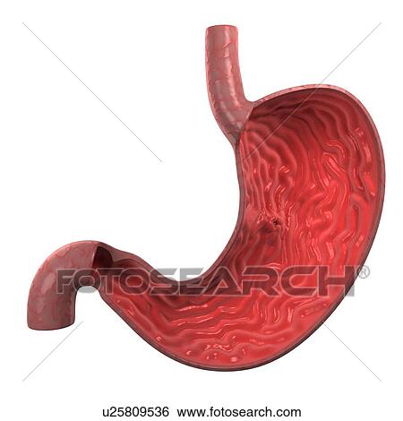 Stock Photograph - Stomach ulcer, computer artwork.. Fotosearch