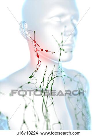 Picture - Swollen lymph nodes in the neck, computer artwork.. Fotosearch