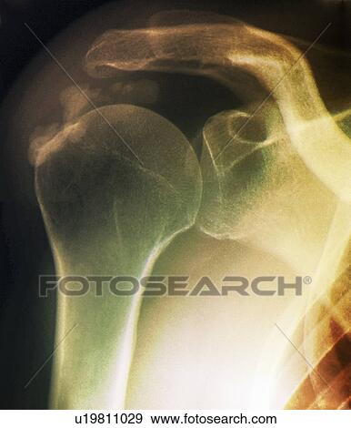 Stock Photo - Tendinitis of the shoulder. Coloured X-ray of the shoulder of a patient showing calcification (grainy patches) around the rotator cuff tendon (upper left).. Fotosearch