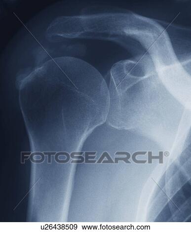 Stock Photo - Tendinitis of the shoulder. Coloured X-ray of the shoulder of a patient showing calcification (grainy patches) around the rotator cuff tendon (upper left).. Fotosearch