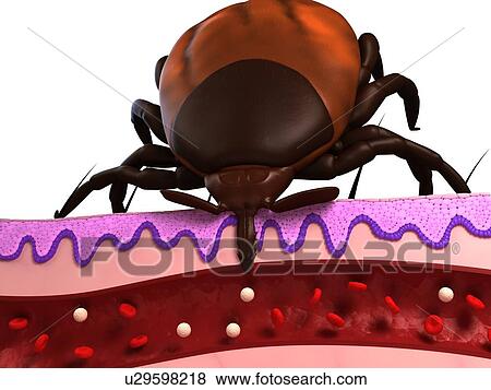 Tick feeding. Computer artwork of a tick (superfamily Ixodoidea) feeding, showing a cross-section through skin. View Large Photo Image Stock Photo - Tick feeding. Computer artwork of a tick (superfamily Ixodoidea) feeding, showing a cross-section through skin.. Fotosearch