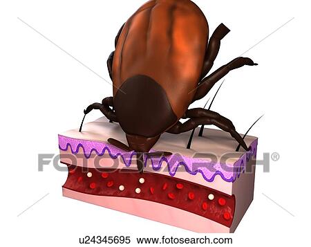 Stock Photography - Tick feeding. Computer artwork of a tick (superfamily Ixodoidea) feeding, showing a cross-section through skin.. Fotosearch