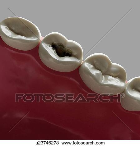 Stock Photo - Tooth decay. Computer artwork of a tooth with cavities.. Fotosearch