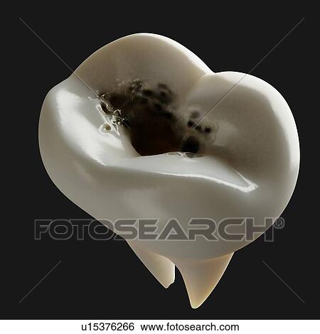 Stock Photograph - Tooth decay. Computer artwork of a tooth with cavities.. Fotosearch