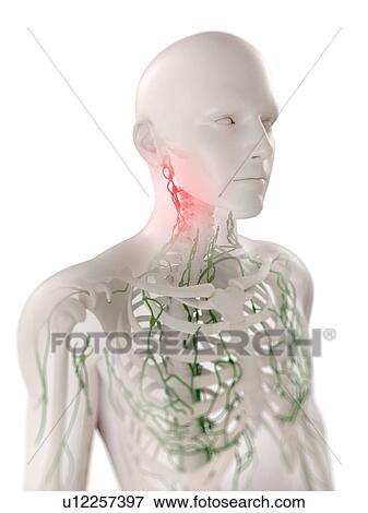Bild - geschwollen, lymphknoten, in, dass, hals, edv, artwork. u12257397 - Suche Stockfotografie ...