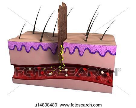Stock Image - Wound infection. Computer artwork of bacteria (green) infecting a wound.. Fotosearch