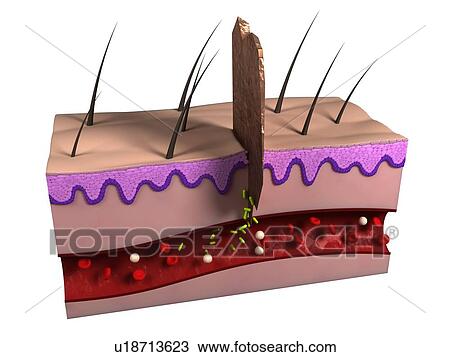 Stock Image - Wound infection. Computer artwork of bacteria (green) infecting a wound.. Fotosearch