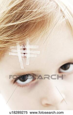 Young boy with head wound. The wound is closed with steri-strips. View Large Photo Image Stock Photography - Young boy with head wound. The wound is closed with steri-strips.. Fotosearch