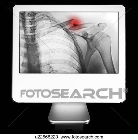 Arm fracture appearing on diagnostic monitor View Large Photo Image Stock Image - Arm fracture appearing on diagnostic monitor. Fotosearch