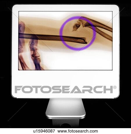 Bone fracture appearing on diagnostic monitor View Large Photo Image Stock Photo - Bone fracture appearing on diagnostic monitor. Fotosearch