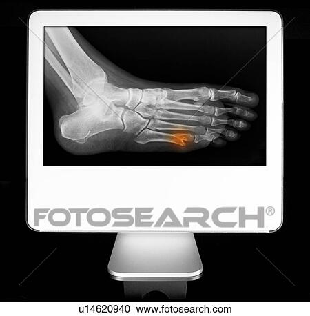 Broken toe appearing on diagnostic monitor View Large Photo Image Stock Image - Broken toe appearing on diagnostic monitor. Fotosearch