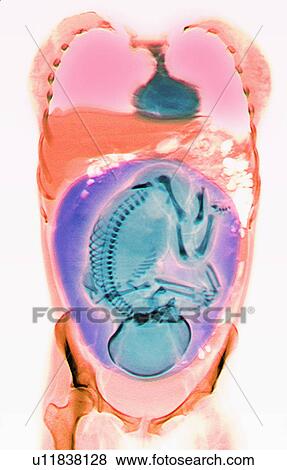 Stock Photo - CT scan of abdomen of 25 year old pregnant woman with full term fetus.. Fotosearch