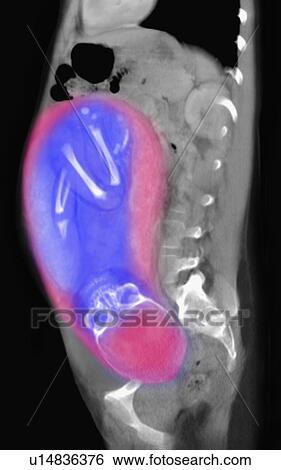 CT scan of abdomen of 25 year old pregnant woman with full term fetus. View Large Photo Image Stock Photograph - CT scan of abdomen of 25 year old pregnant woman with full term fetus.. Fotosearch