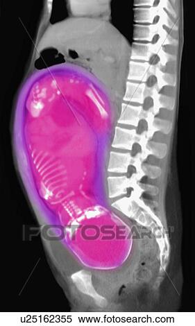 CT scan of abdomen of 25 year old pregnant woman with full term fetus. View Large Photo Image Stock Photography - CT scan of abdomen of 25 year old pregnant woman with full term fetus.. Fotosearch