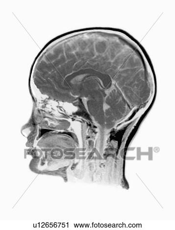 MRI Scan of human head View Large Photo Image Stock Image - MRI Scan of human head. Fotosearch