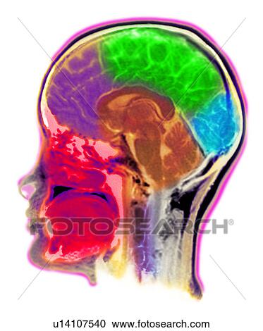 Stock Image - MRI Scan of human head. Fotosearch