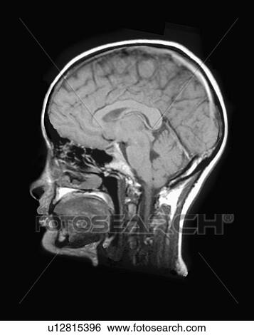 Stock Photograph - MRI Scan of human head. Fotosearch