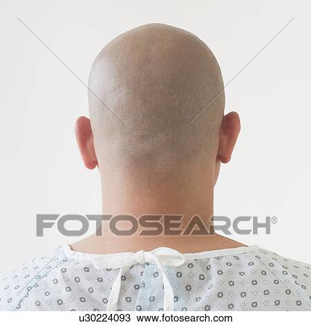 Back view of patient with shaved head View Large Photo Image Stock Image - Back view of patient with shaved head. Fotosearch