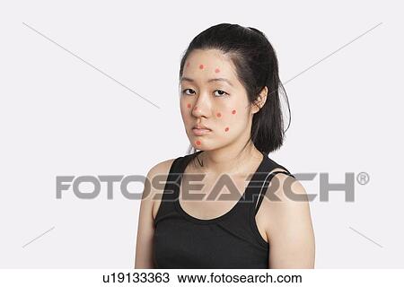 Stock Image - Portrait of an young woman suffering from measles. Fotosearch