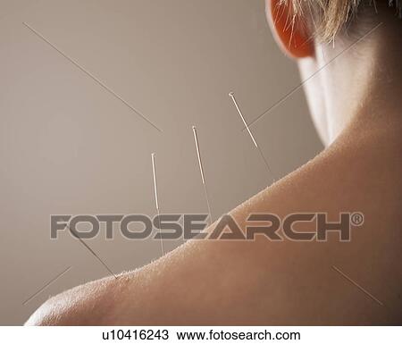 Close-up of Acupuncture needles in back View Large Photo Image Stock Image - Close-up of Acupuncture needles in back. Fotosearch